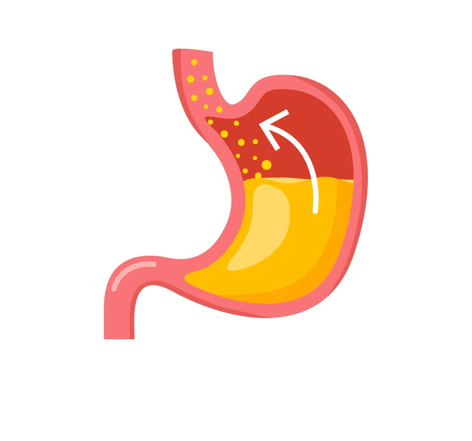 illustration d'un estomac avec reflux gastro-œsophagien